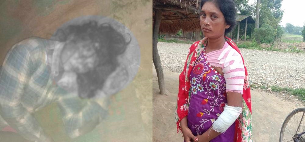 श्रीमानले निर्घात कुटेर श्रीमतीलाई गम्भीर घाइते बनाए